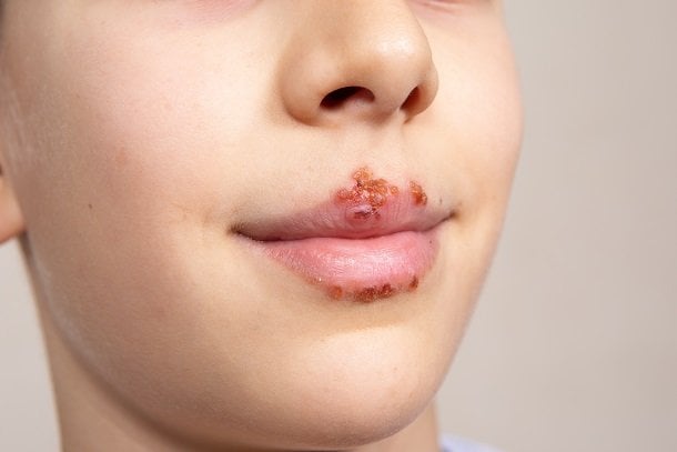 Lippenherpes: Herpes an der Lippe als häufigste Form