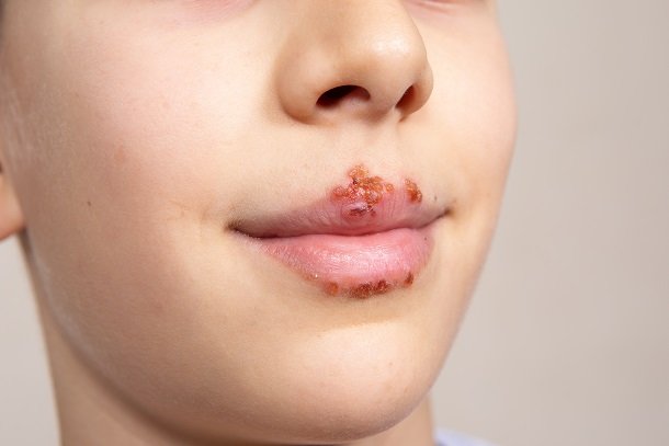 Lippenherpes: Herpes an der Lippe als häufigste Form Lippenherpes: Herpes an der Lippe als häufigste Form