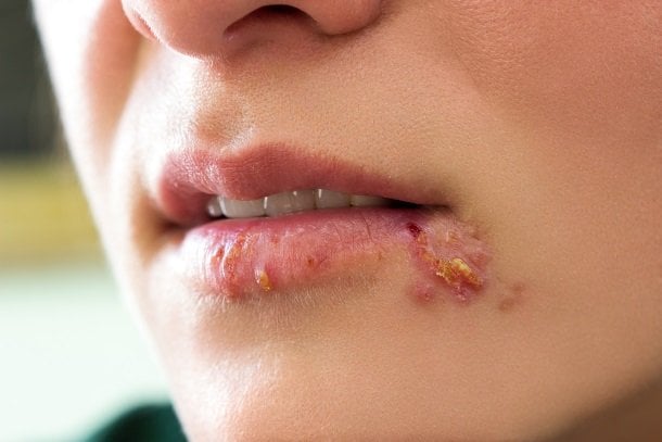 Herpes am Mund oder Mundwinkel