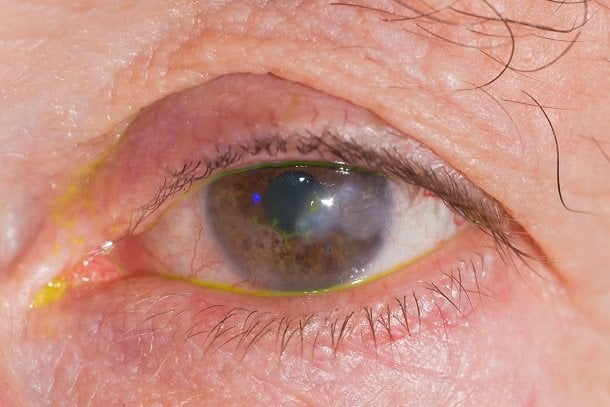 Augenherpes: Herpes im Auge