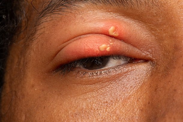 Herpes am Auge Herpes am Auge