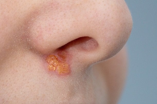 Nasenherpes – Herpes an der Nase