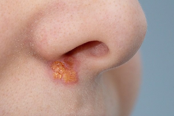 Nasenherpes – Herpes an der Nase Nasenherpes – Herpes an der Nase