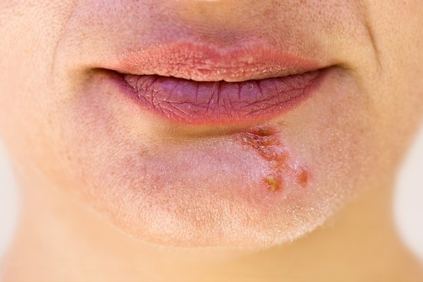 Herpes im Gesicht, zum Beispiel am Kinn Herpes im Gesicht, zum Beispiel am Kinn