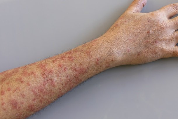 Herpes an anderen Stellen am Körper Herpes an anderen Stellen am Körper