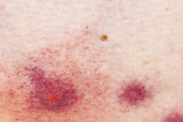Allergische Reaktion nach Mückenstich Allergische Reaktion nach Mückenstich