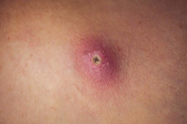 Abszesse im Intimbereich Abszesse im Intimbereich