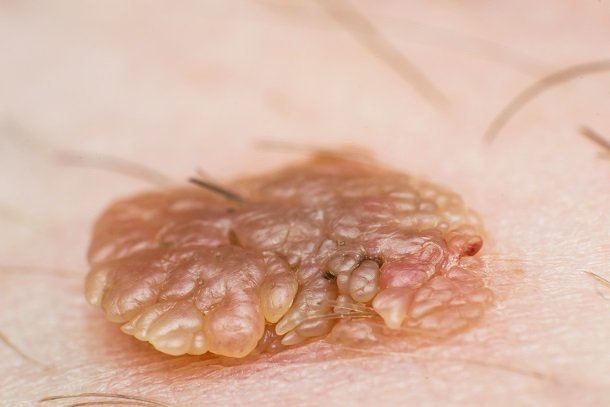 Feigwarzen (Kondylome) Feigwarzen (Kondylome)