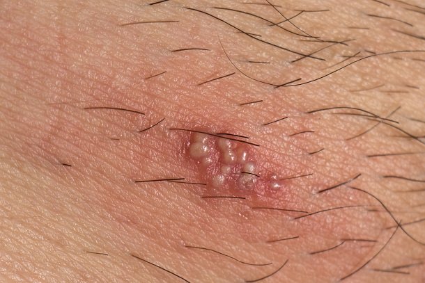 Herpes im Intimbereich Herpes im Intimbereich