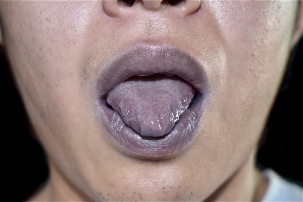 Blaue Lippen, Zunge und Mundschleimhäute durch Lungenembolie