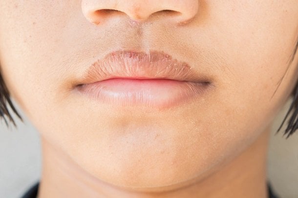 Schrunden: trockene Haut und eingerissene Mundwinkel
