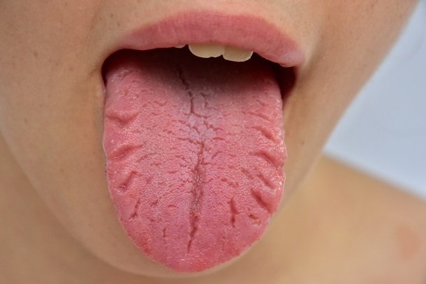 Zungenbrennen und Risse in der Zunge
