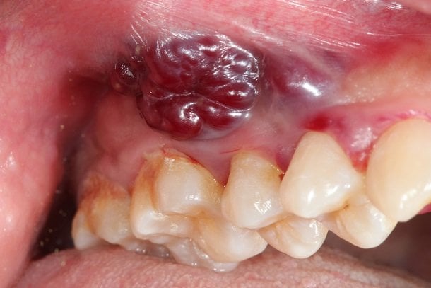 Mundhöhlenkrebs und Rachenkrebs