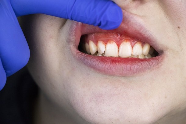 Zahnfleischentzündung (Gingivitis) Zahnfleischentzündung (Gingivitis)