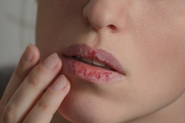 Trockene Lippen und Lippenentzündung Trockene Lippen und Lippenentzündung