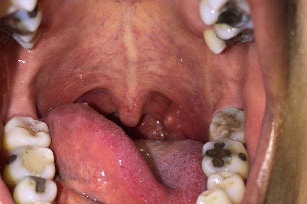 Mandelentzündung (Tonsillitis) Mandelentzündung (Tonsillitis)