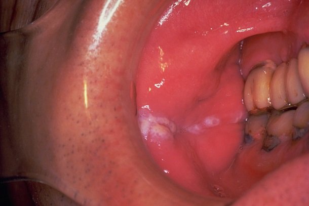 Orale Leukoplakie Orale Leukoplakie