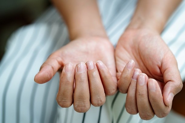 Häufige Nagelveränderungen Häufige Nagelveränderungen
