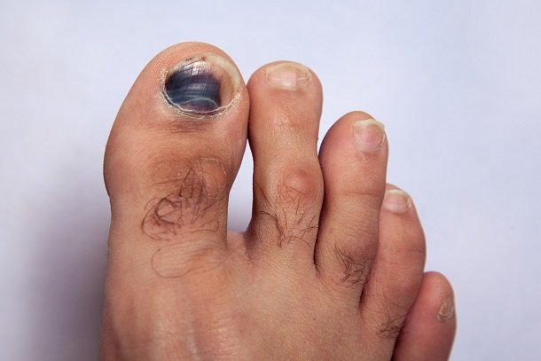 Schwarze oder blaue Nägel Schwarze oder blaue Nägel