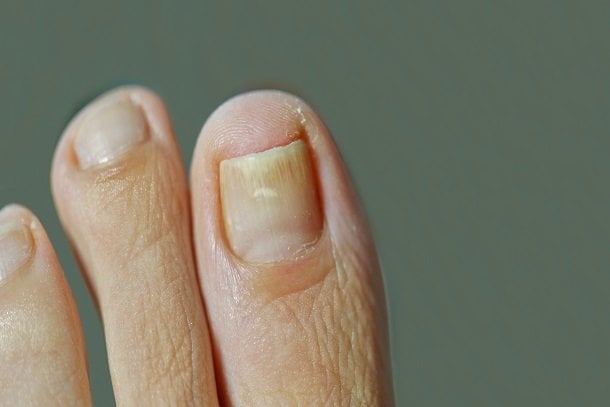 Gelbe Finger- und Fußnägel Gelbe Finger- und Fußnägel