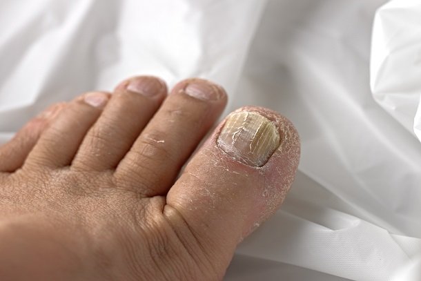 Nagelpilz Nagelpilz