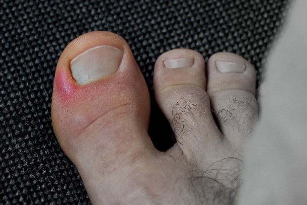 Nagelbettentzündung Nagelbettentzündung