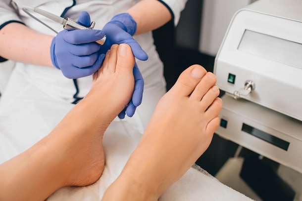 Nagelpilz mit Laser behandeln