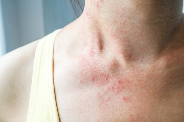 Typische Symptome bei Neurodermitis Typische Symptome bei Neurodermitis