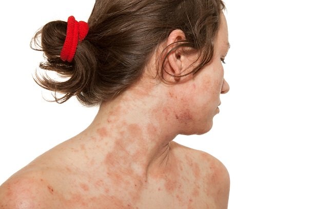 Lichenifikation Lichenifikation