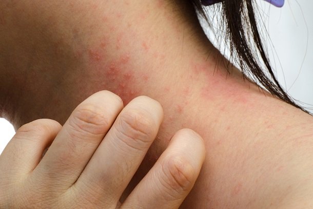 Neurodermitis am Hals Neurodermitis am Hals