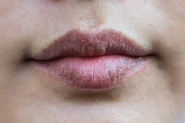 Trockene Lippen durch Neurodermitis