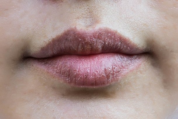 Trockene Lippen durch Neurodermitis Trockene Lippen durch Neurodermitis