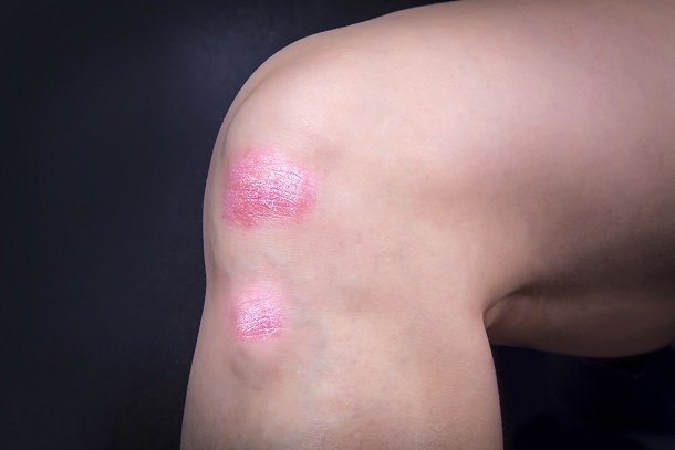 Psoriasis inversa