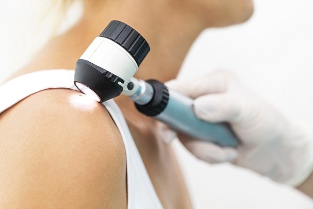 Veränderte Leberflecken als Symptom von Krebs Veränderte Leberflecken als Symptom von Krebs