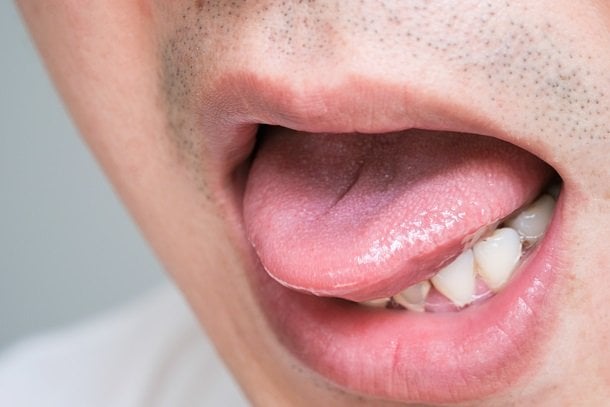 Brennende Zunge – ein Symptom für Vitamin-B12-Mangel