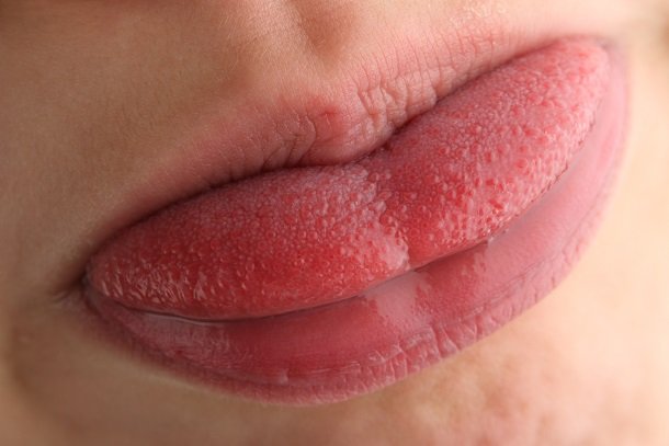 Rote Zunge (Himbeerzunge) Rote Zunge (Himbeerzunge)