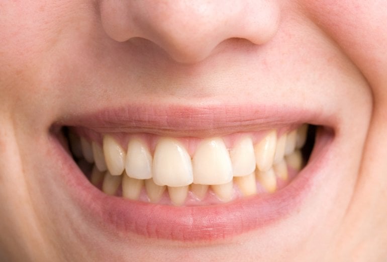 Frau mit gelben Zähnen