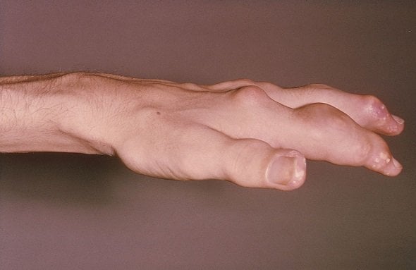 Gichtknoten am Finger