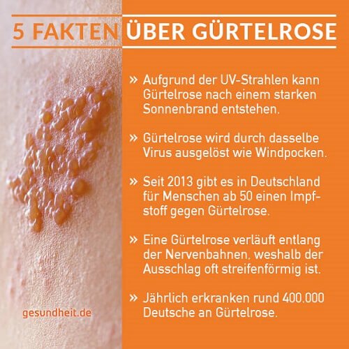 5 Fakten über Gürtelrose (Infografik)