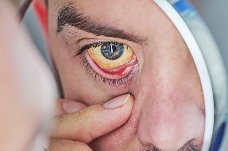 Mann mit Hepatitis C betrachtet gelbes Auge im Spiegel