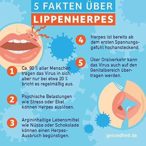 5 Fakten über Lippenherpes (Infografik)