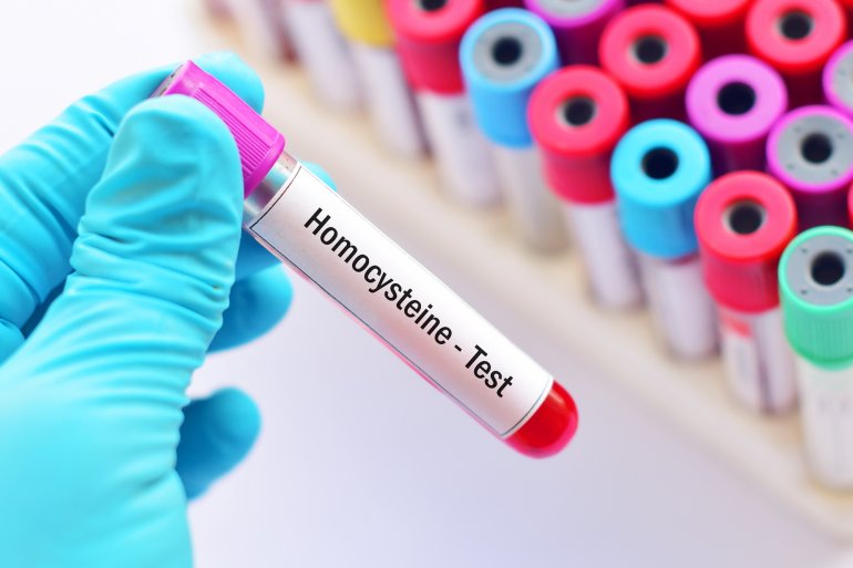 Blutprobe für Homocystein-Test