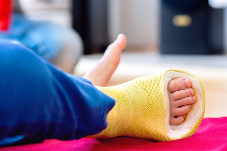 Knochenbruch: Gebrochenes Bein im Gips