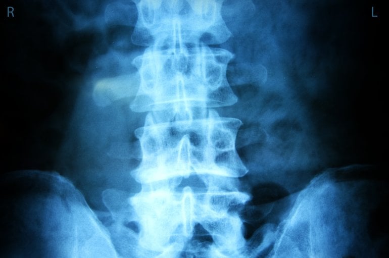 Lumbalpunktion: Röntgenbild von Rücken