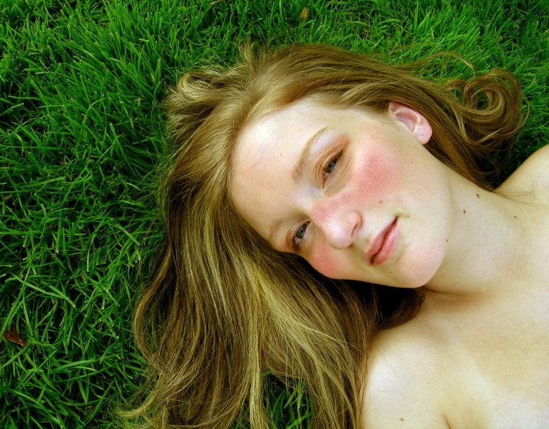 Junge Frau mit für Lupus typischer Rötung im Gesicht