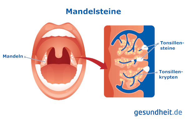 Mandelsteine (Infografik)