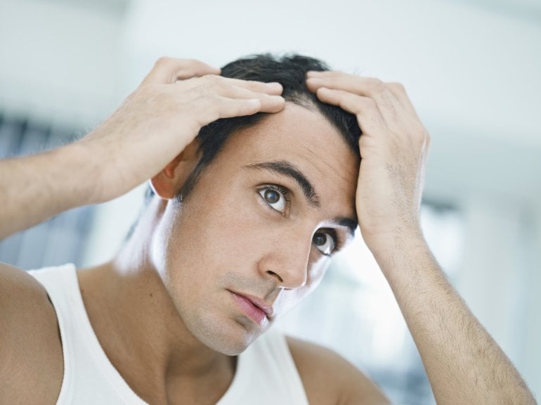 MInoxidil: Mann mit Haarausfall