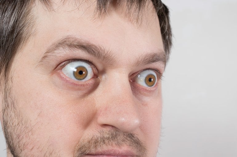 Mann mit Exophthalmus (heraustretenden Augen) durch Morbus Basedow