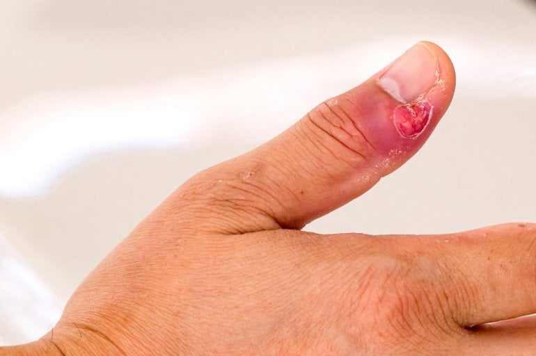 Nagelbettentzündung am Finger