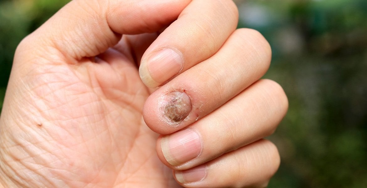 Nagelpilz